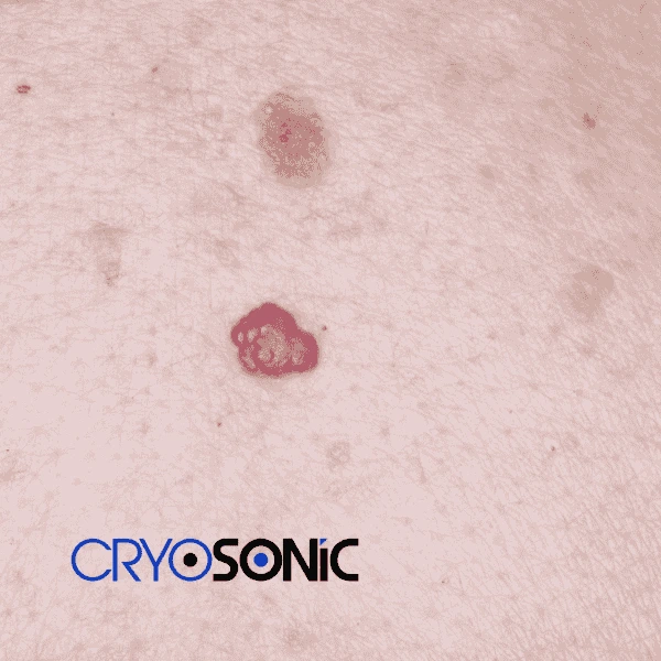Looking for pain free cherry angioma removal treatment Southampton? Call our team today! Southampton