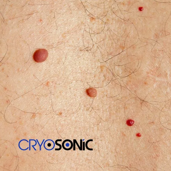 get cherry angioma removal treatment today! Southampton