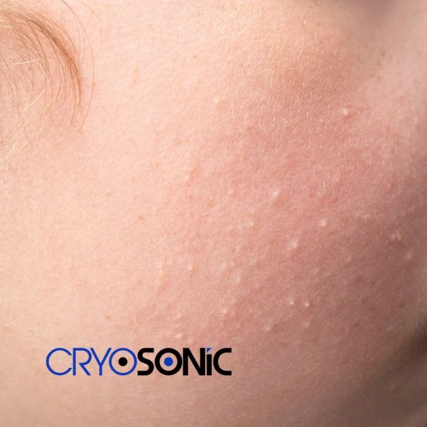 Are you looking for milia removal treatment? Contact our team today Southampton