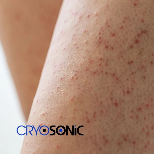 Looking for Seborrhoeic Keratosis removal Southampton treatment? Call our consultants today in Southampton