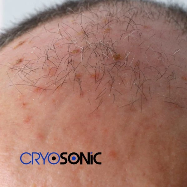 Access Seborrhoeic Keratosis removal from the comfort of your own home! Call us today in Southampton
