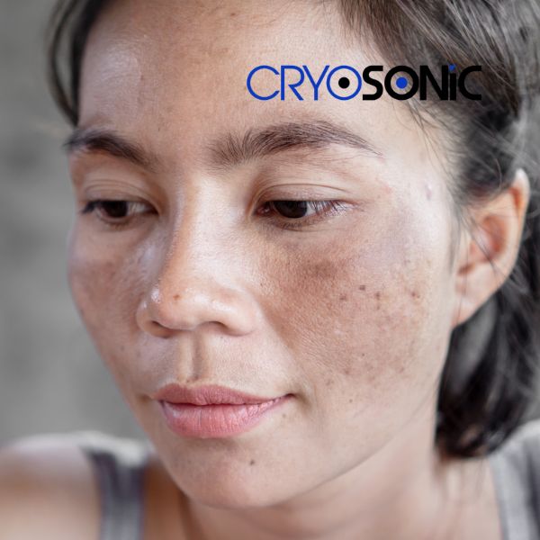 Ready to start age spots removal? Contact our team today in Southampton