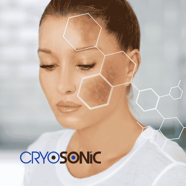 Are you looking for age spot removal treatment? Contact Cryosonic today in Southampton