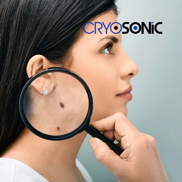 Do you want to learn more about benign moles removal treatment? Call our team today Southampton
