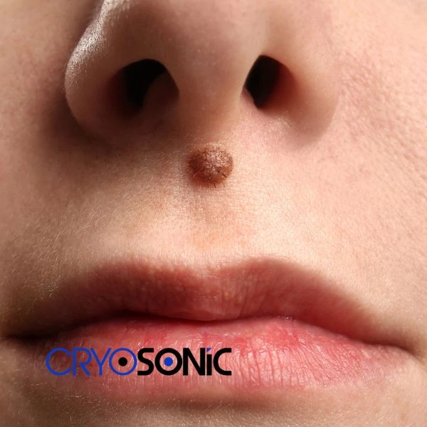 Start your benign moles removal treatment today Southampton