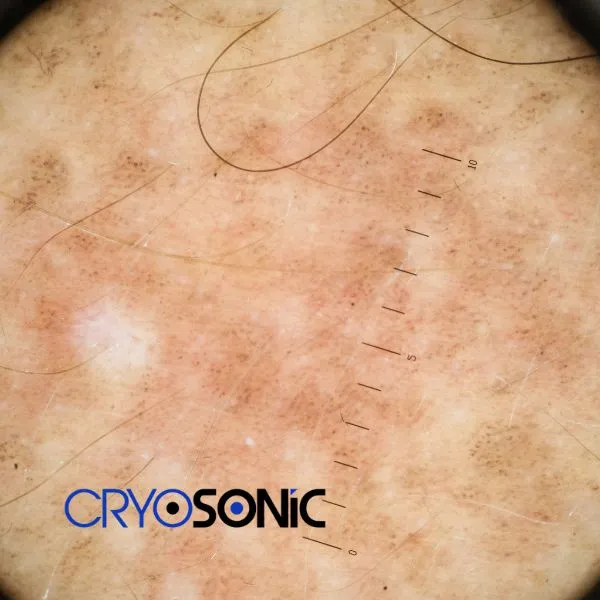 Speak to our team today about sun damaged skin treatment today in Southampton