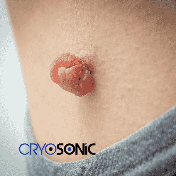 Book your skin tags removal Southampton from comfort of your own home! Southampton