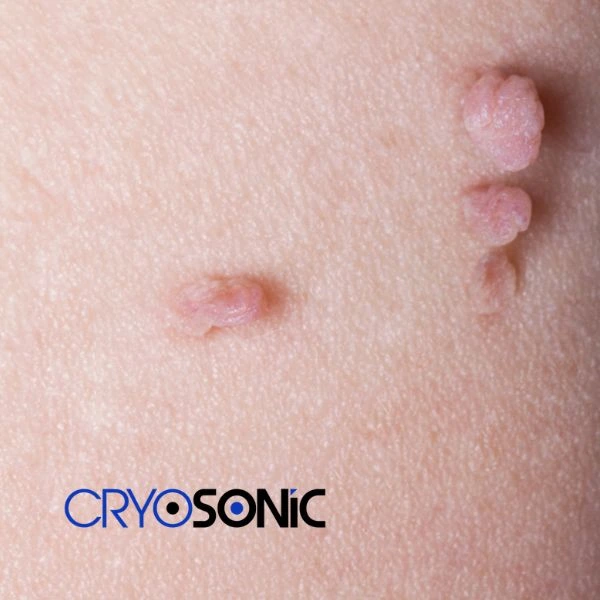 Are you looking for fast effect skin tag removal Southampton? Book in NOW! Southampton