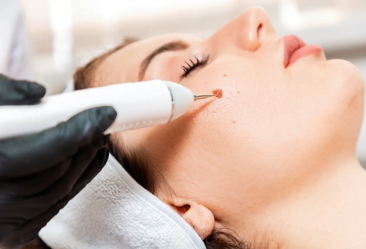 Frequently Asked Questions About Multiple Cryotherapy Treatments Southampton