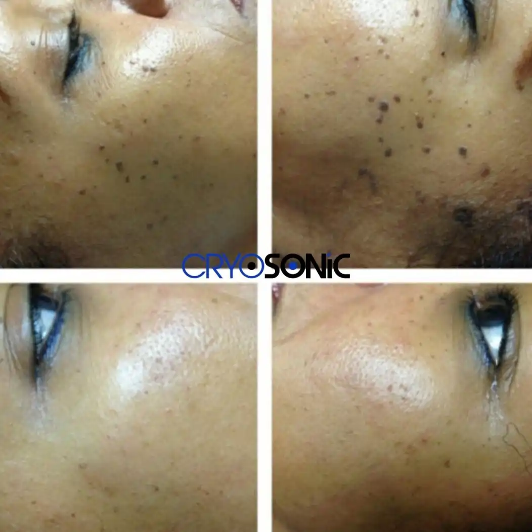 Why Skin Shows Pigmentation After Treatment Southampton
