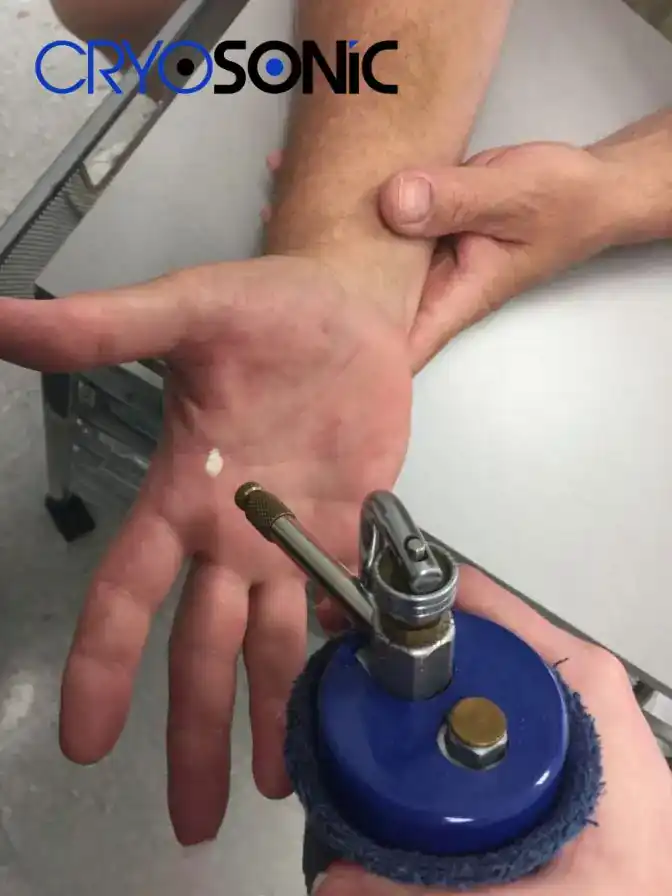 Temperature Differences: OTC vs Medical-Grade Cryotherapy Southampton